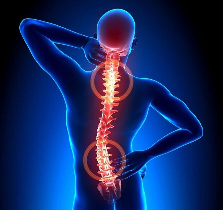 Osteocondrose da columna vertebral como causa de dores nas costas