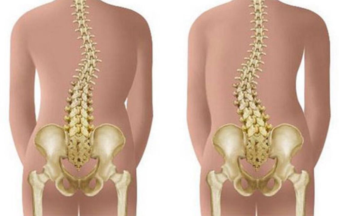 Escoliose como causa de dor nas costas na zona do omóplato