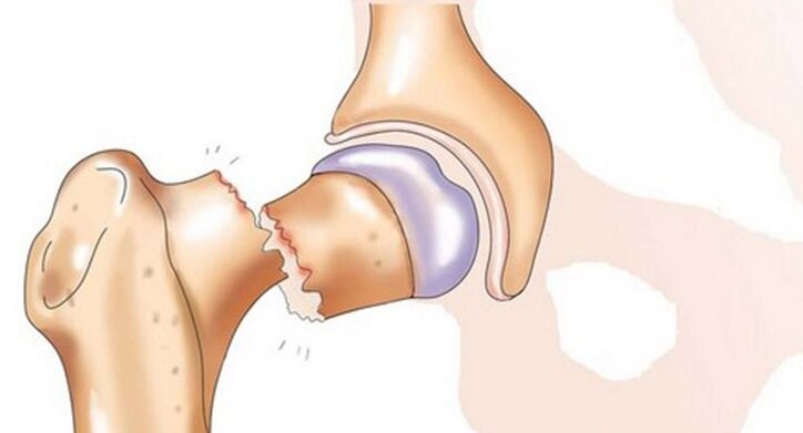 Unha fractura do pescozo femoral está asociada con dor severa na articulación da cadeira
