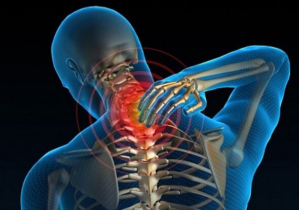 Dor cervical por osteocondrose
